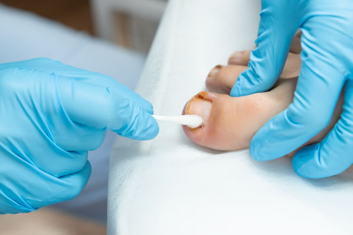 Can You Have a Pedicure with Athlete’s Foot?