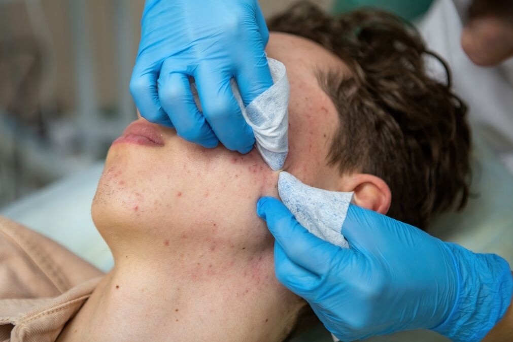 Does Pre-Workout Cause Acne?